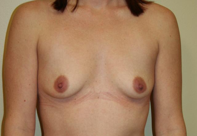Breast Augmentation before at Aesthetic Plastic Surgery Associates in Knoxville, TN