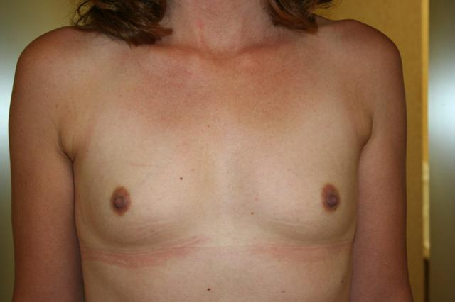 Breast Augmentation before at Aesthetic Plastic Surgery Associates in Knoxville, TN