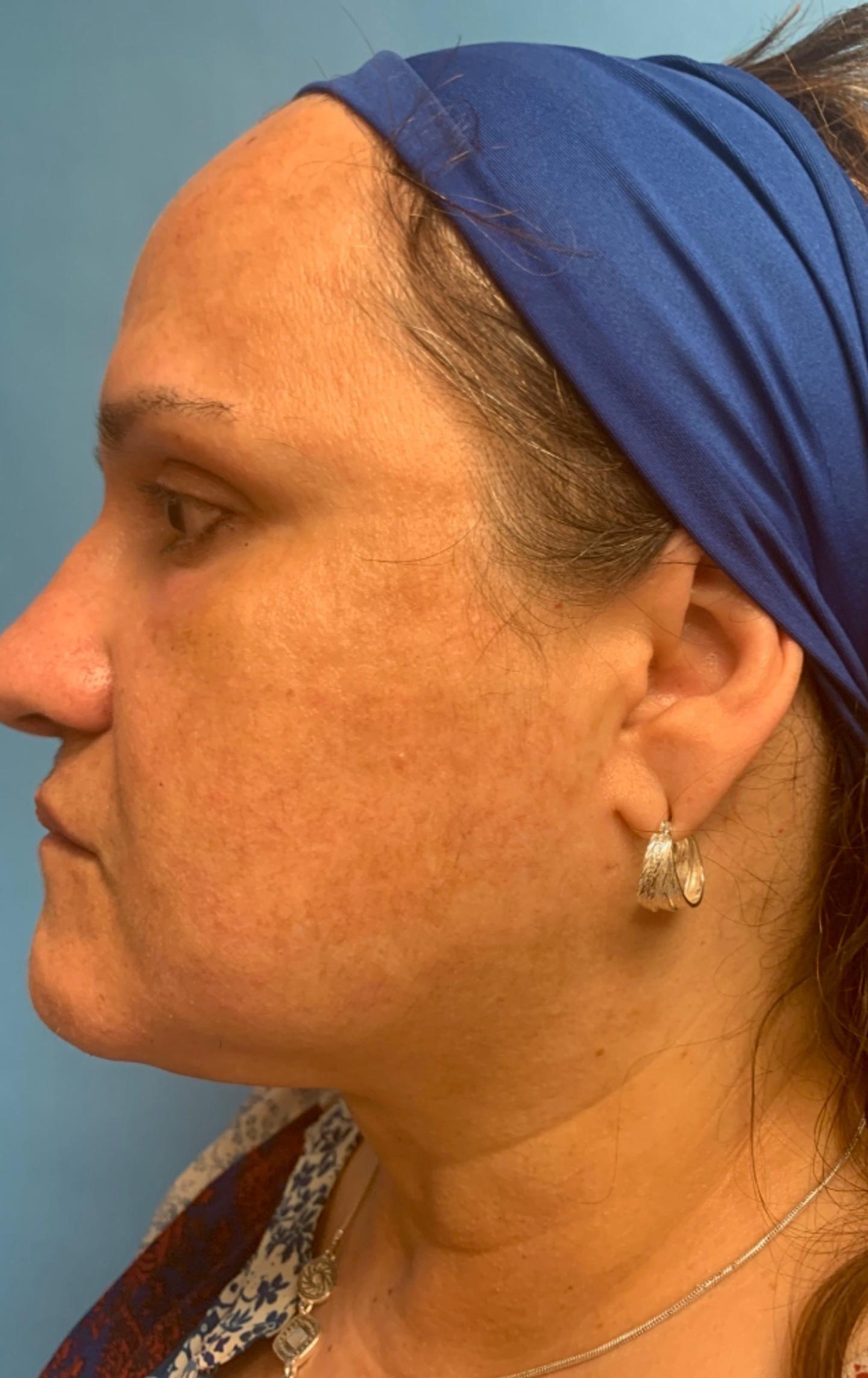 Zormeier Cosmetic Surgery and Longevity Center facelift after — Noblesville, IN