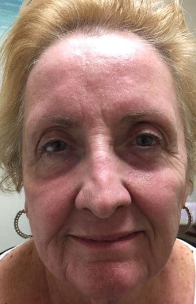 Blepharoplasty after at Zormeier Cosmetic Surgery and Longevity Center in Noblesville, IN