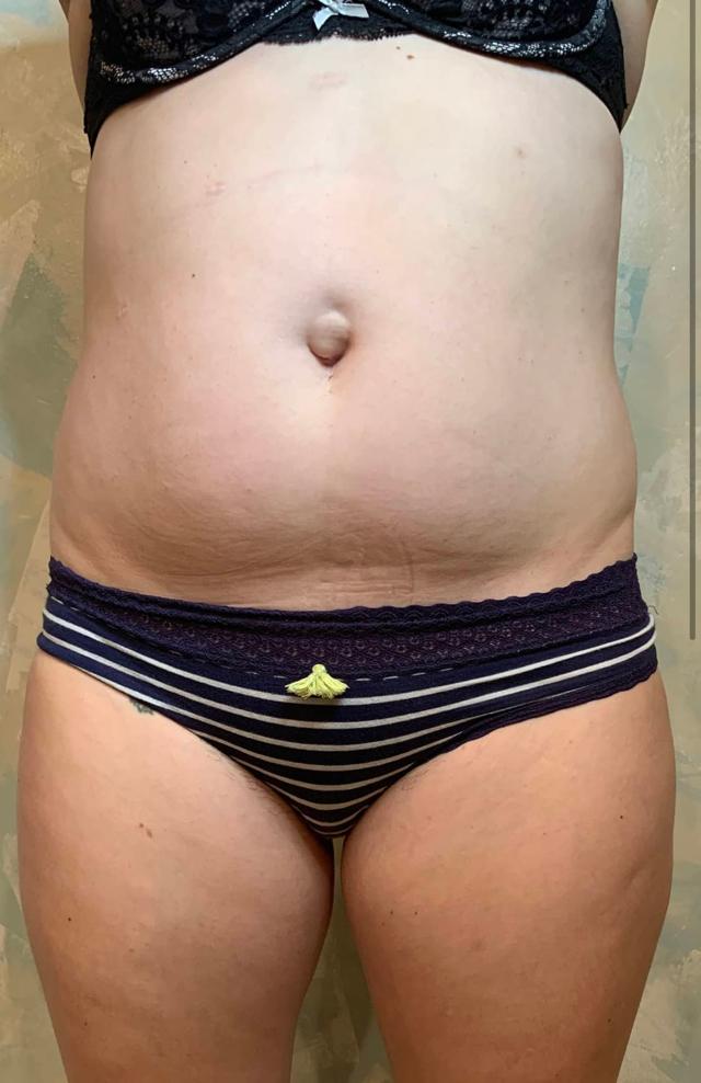 Liposuction before at Zormeier Cosmetic Surgery and Longevity Center in Noblesville, IN