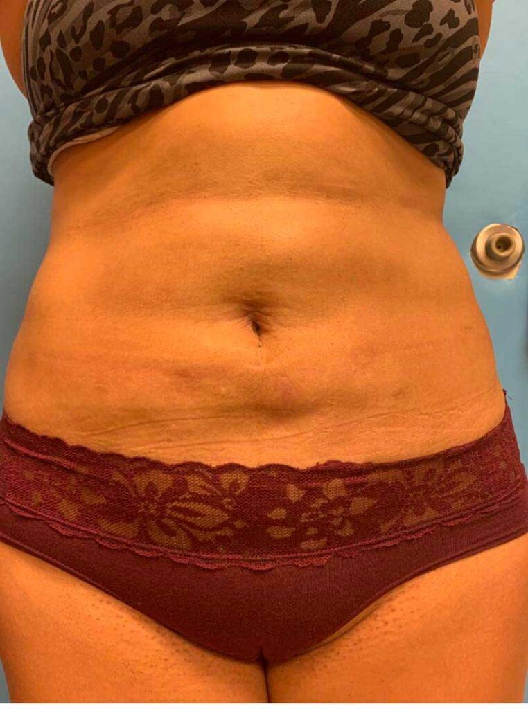 Zormeier Cosmetic Surgery and Longevity Center after — Noblesville, IN