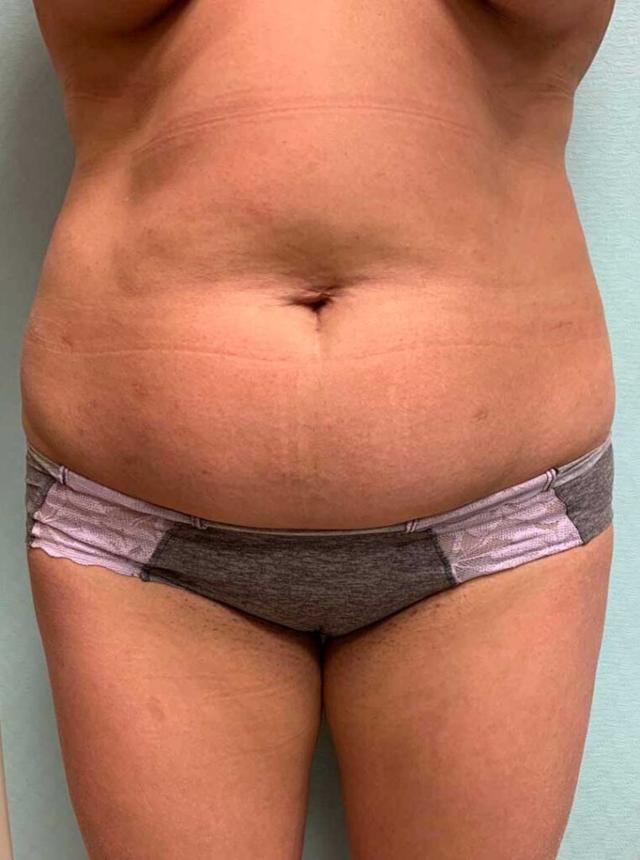 Liposuction before at Zormeier Cosmetic Surgery and Longevity Center in Noblesville, IN