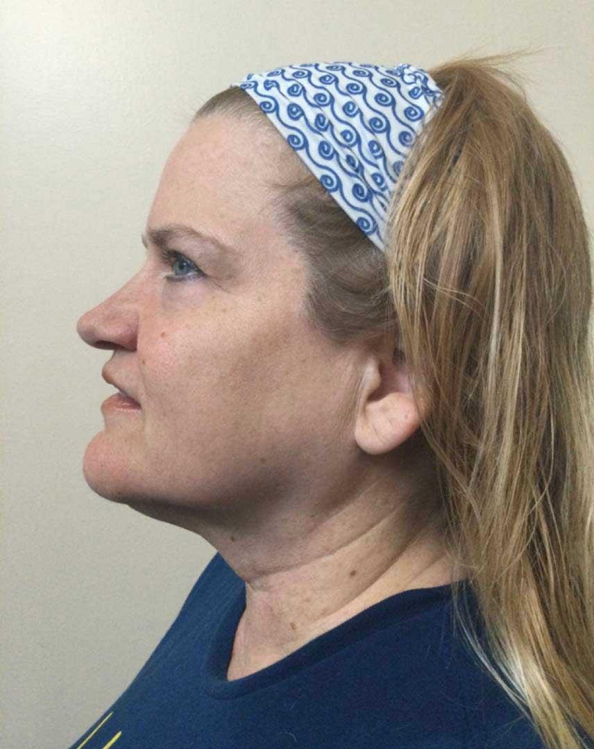 Zormeier Cosmetic Surgery and Longevity Center facelift after — Noblesville, IN
