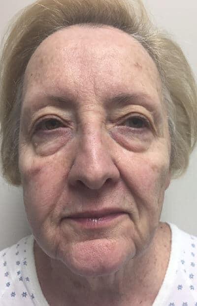 Blepharoplasty before at Zormeier Cosmetic Surgery and Longevity Center in Noblesville, IN