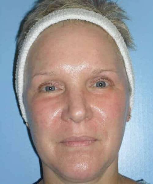 Laser Skin Resurfacing after at Zormeier Cosmetic Surgery and Longevity Center in Noblesville, IN