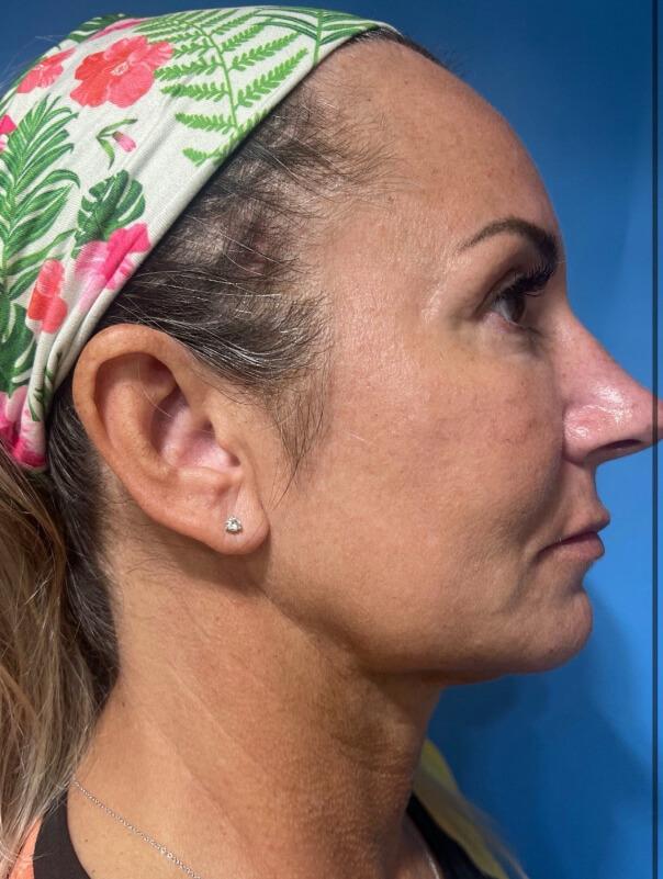 Zormeier Cosmetic Surgery and Longevity Center after — Noblesville, IN