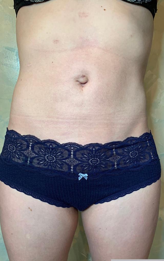 Liposuction after at Zormeier Cosmetic Surgery and Longevity Center in Noblesville, IN