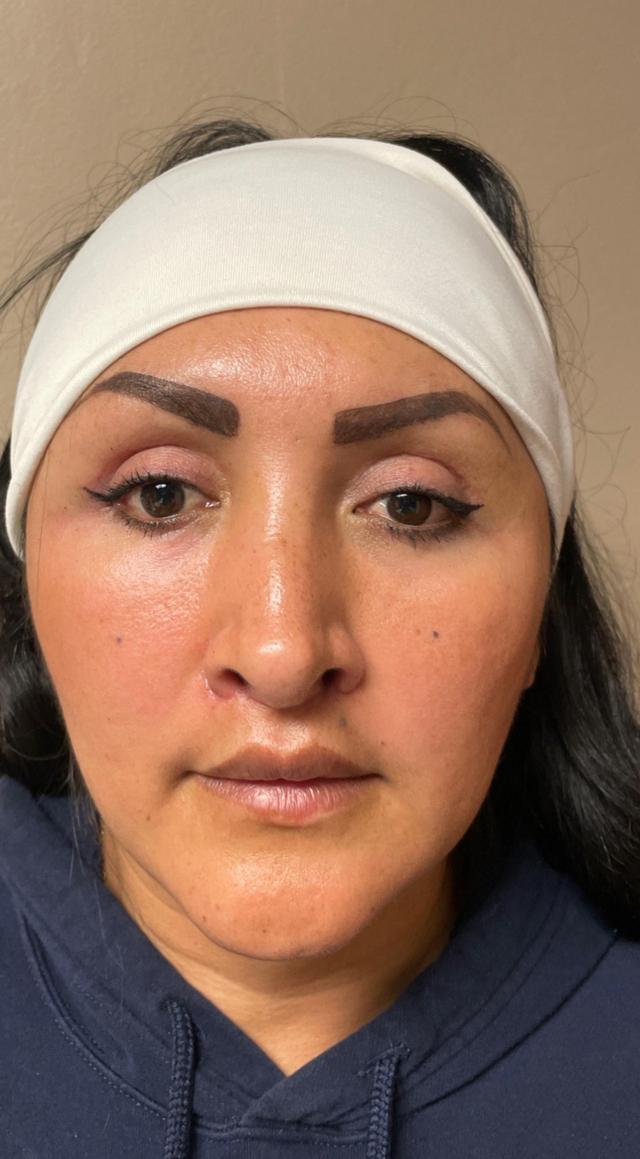Blepharoplasty after at Zormeier Cosmetic Surgery and Longevity Center in Noblesville, IN