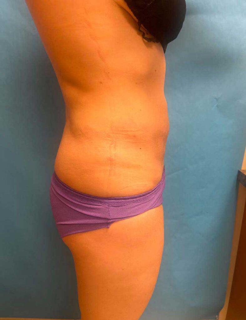 Zormeier Cosmetic Surgery and Longevity Center liposuction after — Noblesville, IN