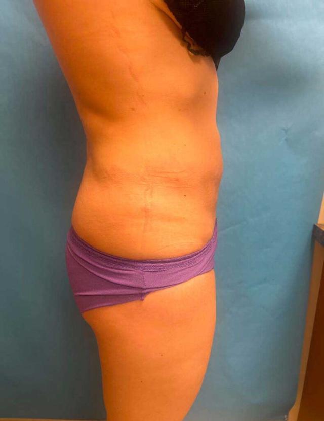 Liposuction after at Zormeier Cosmetic Surgery and Longevity Center in Noblesville, IN