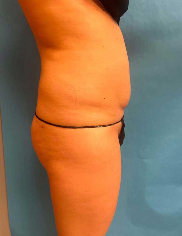 Liposuction before at Zormeier Cosmetic Surgery and Longevity Center in Noblesville, IN