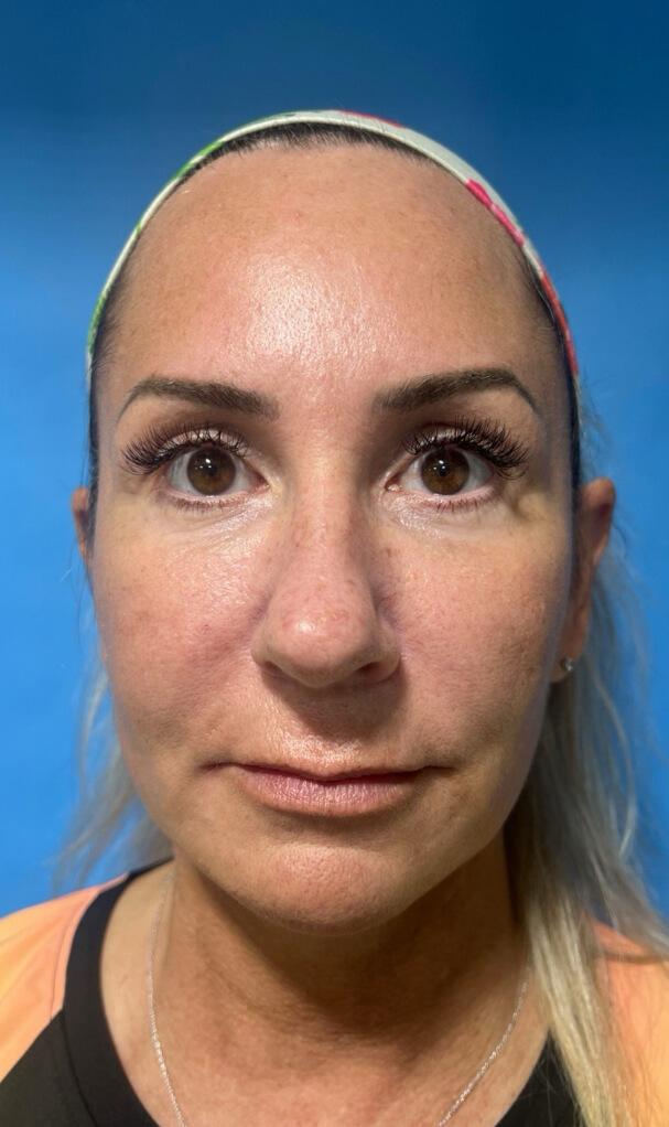 Zormeier Cosmetic Surgery and Longevity Center after — Noblesville, IN