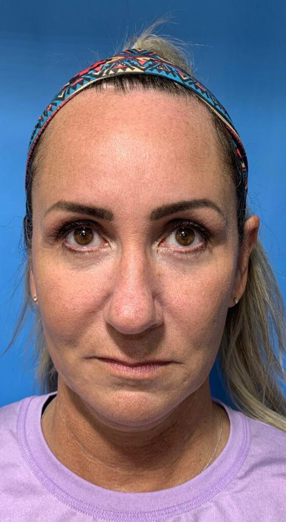 Fat Transfer before at Zormeier Cosmetic Surgery and Longevity Center in Noblesville, IN