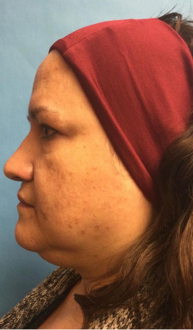 Facelift before at Zormeier Cosmetic Surgery and Longevity Center in Noblesville, IN