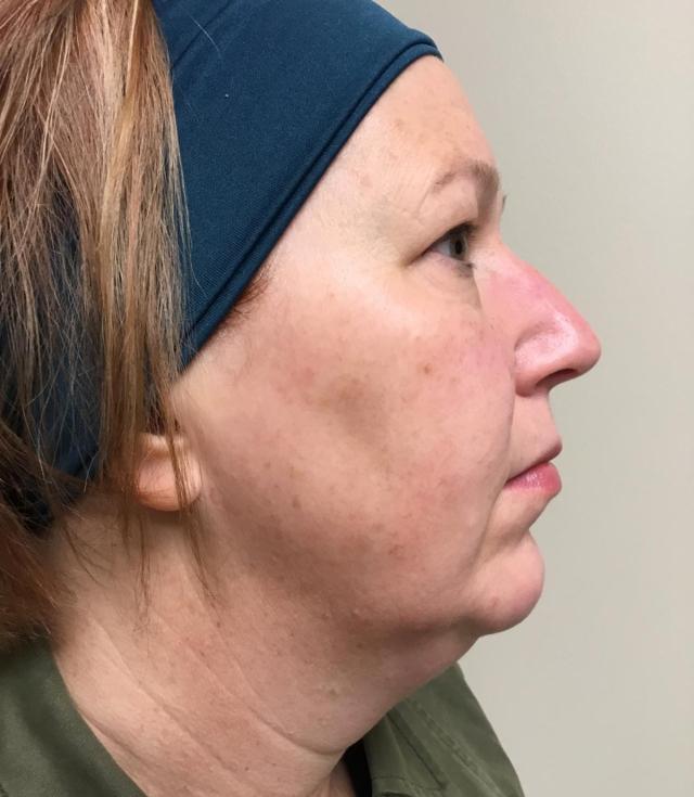 Deep Plane Facelift before at Zormeier Cosmetic Surgery and Longevity Center in Noblesville, IN