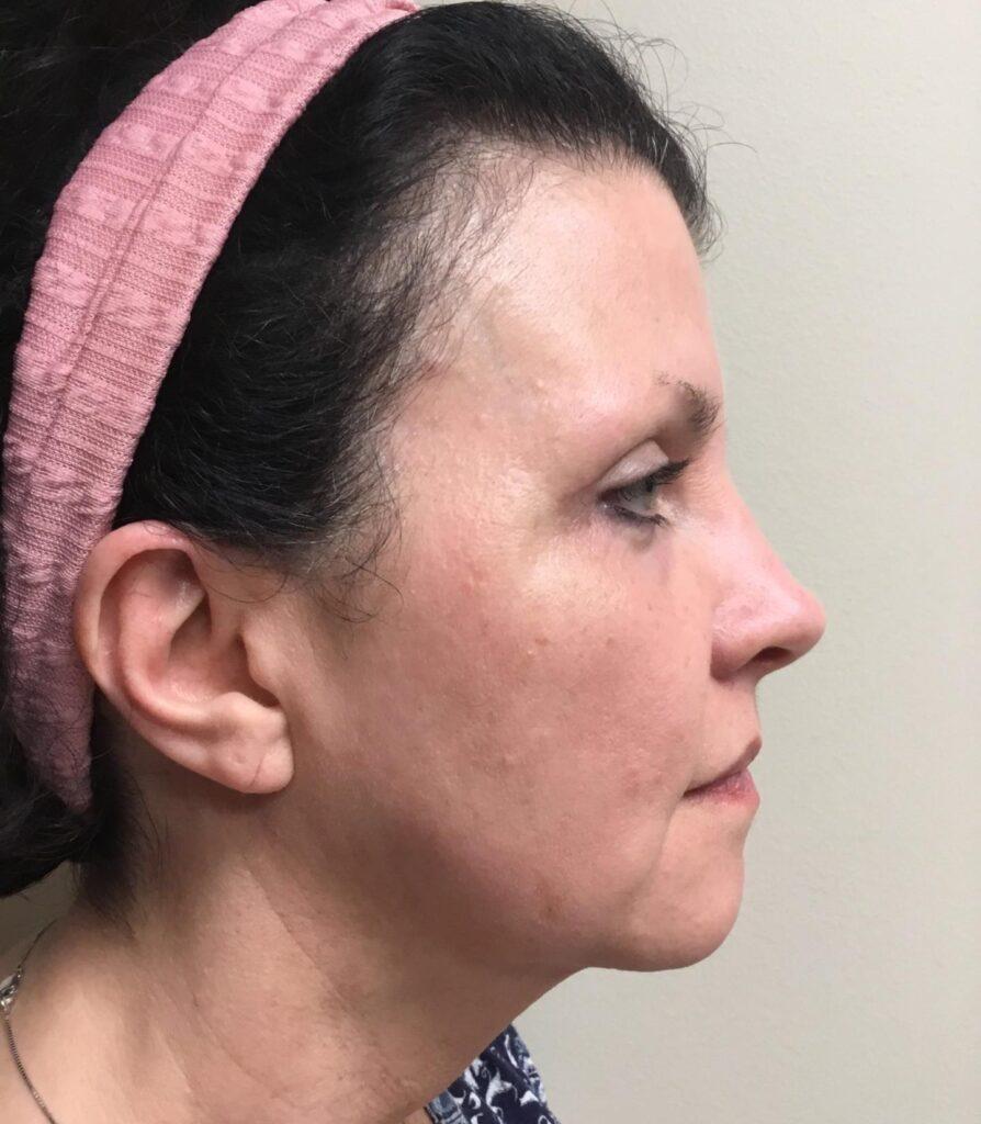 Zormeier Cosmetic Surgery and Longevity Center after — Noblesville, IN