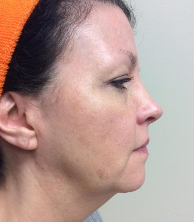 Fat Transfer before at Zormeier Cosmetic Surgery and Longevity Center in Noblesville, IN