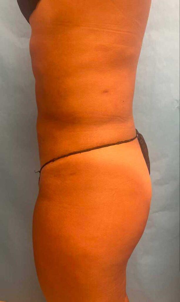 Zormeier Cosmetic Surgery and Longevity Center after — Noblesville, IN