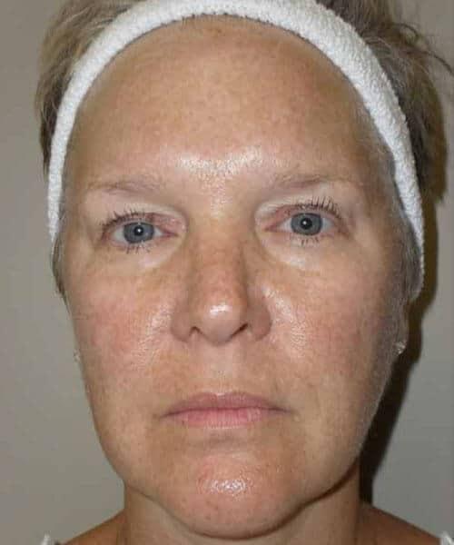 Laser Skin Resurfacing before at Zormeier Cosmetic Surgery and Longevity Center in Noblesville, IN