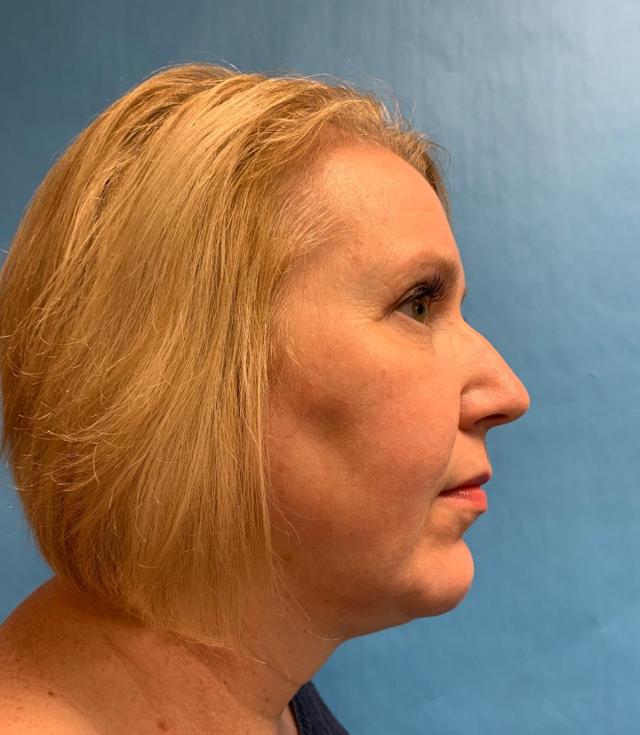 Deep Plane Facelift after at Zormeier Cosmetic Surgery and Longevity Center in Noblesville, IN