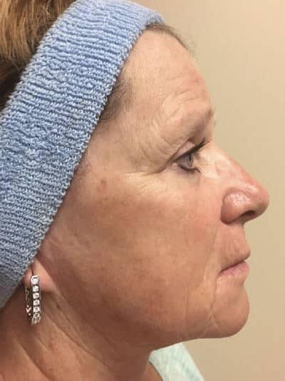 Zormeier Cosmetic Surgery and Longevity Center facelift after — Noblesville, IN
