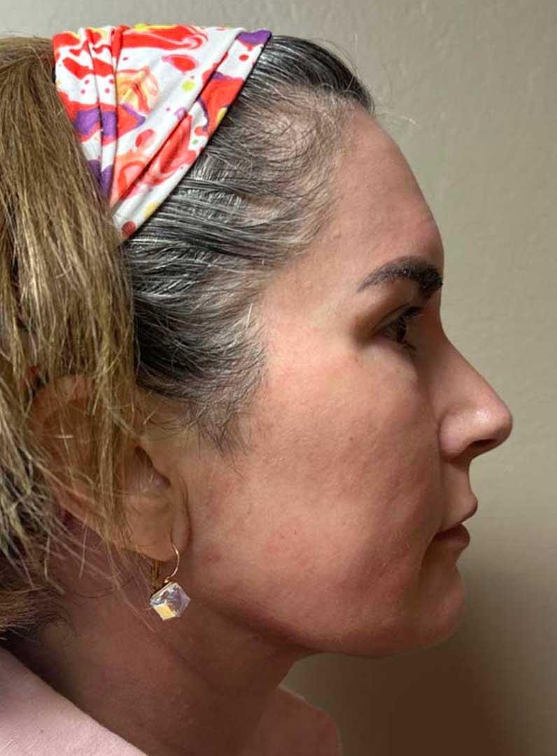 Zormeier Cosmetic Surgery and Longevity Center facelift after — Noblesville, IN