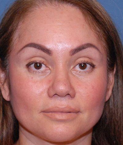 Paul F. Fortes, MD rhinoplasty after — Houston, TX