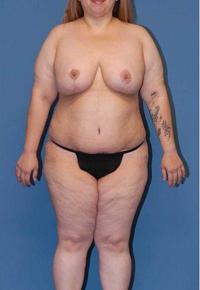 Paul F. Fortes, MD mommy makeover after — Houston, TX
