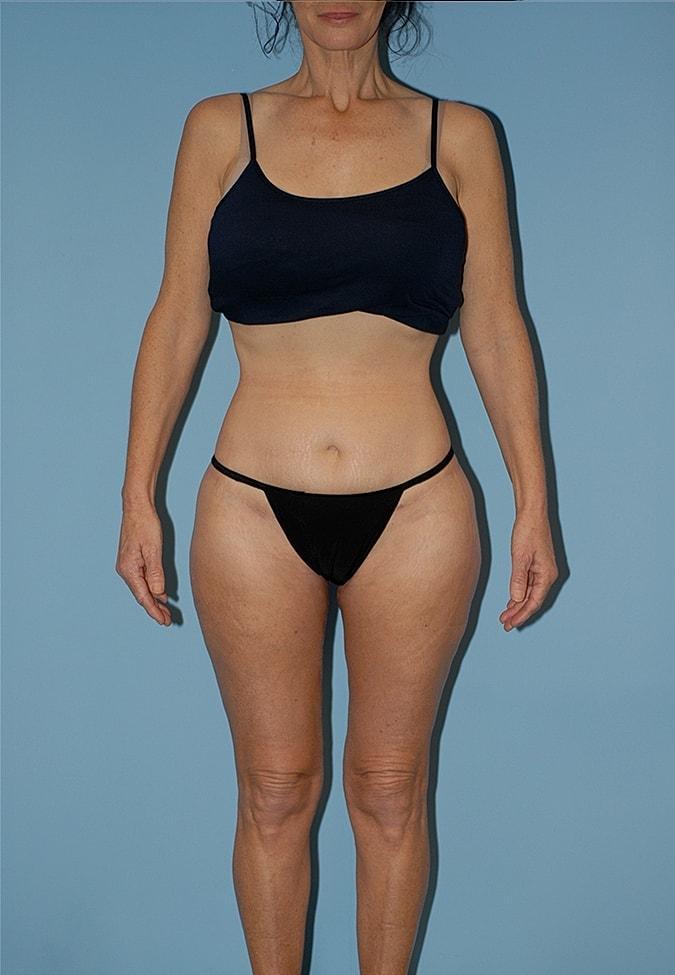 Paul F. Fortes, MD thigh lift after — Houston, TX