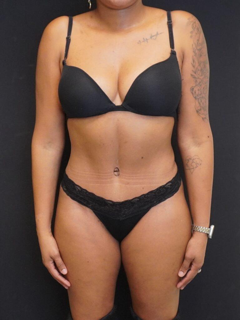 Brian Chang Plastic Surgery tummy tuck after — Alexandria, VA
