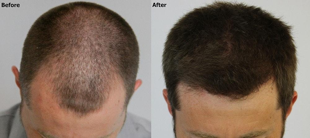 AlviArmani Salt Lake City hair restoration result — Salt Lake City, UT