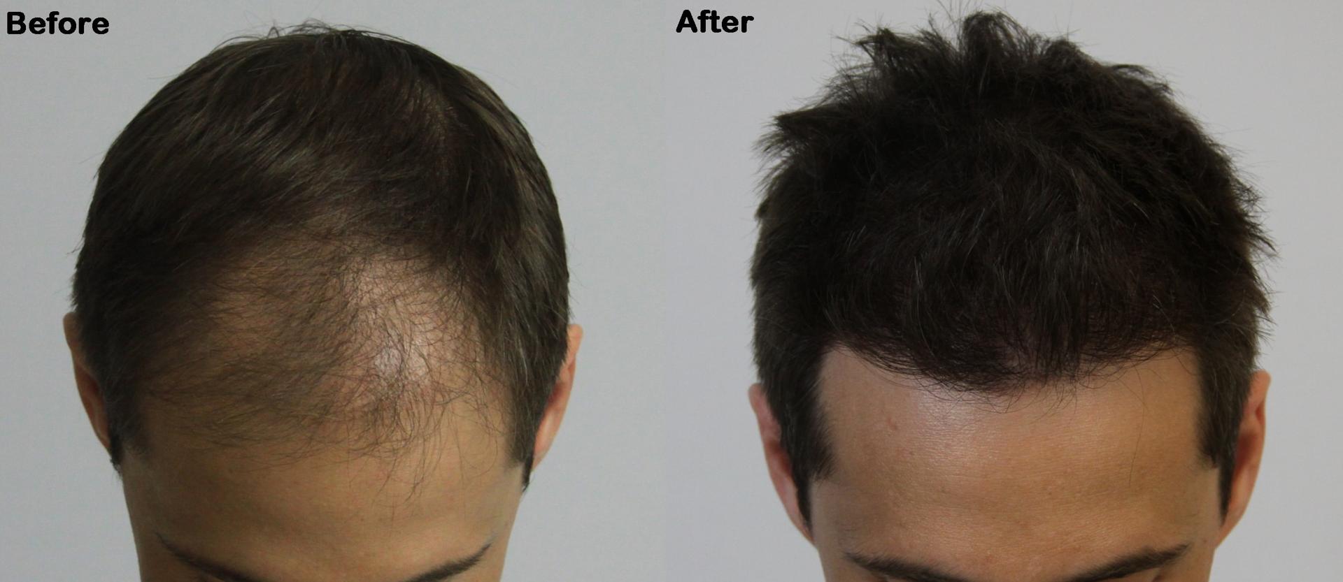 AlviArmani Salt Lake City hair restoration result — Salt Lake City, UT
