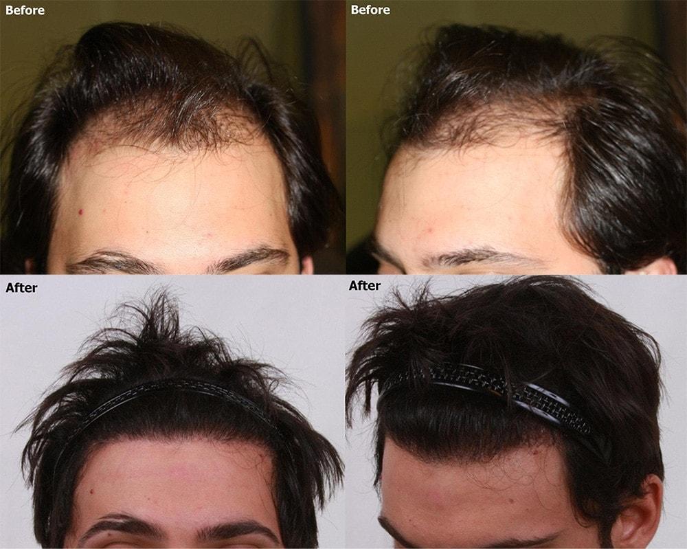 AlviArmani Salt Lake City hair restoration result — Salt Lake City, UT