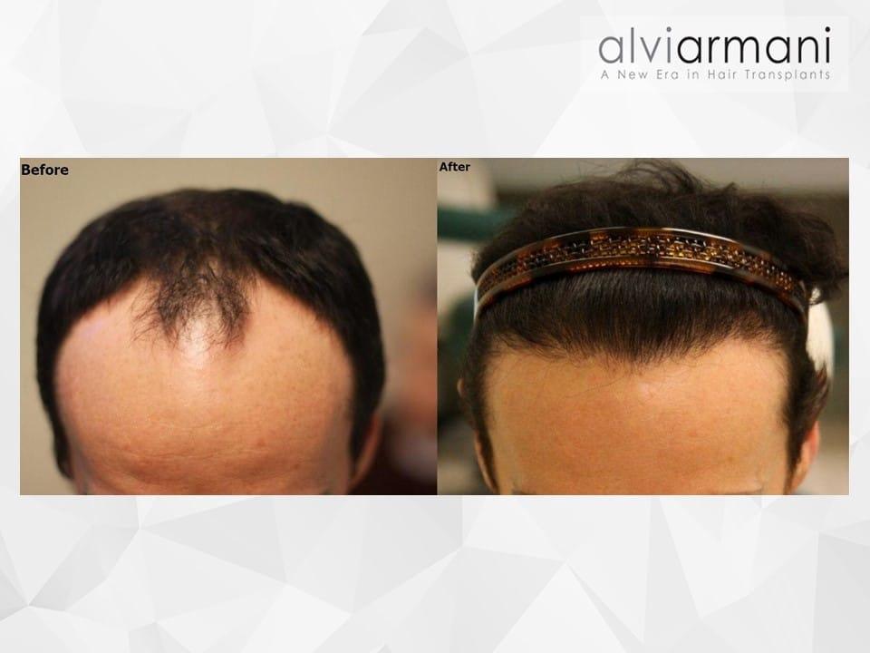 AlviArmani Salt Lake City fue transplant result — Salt Lake City, UT