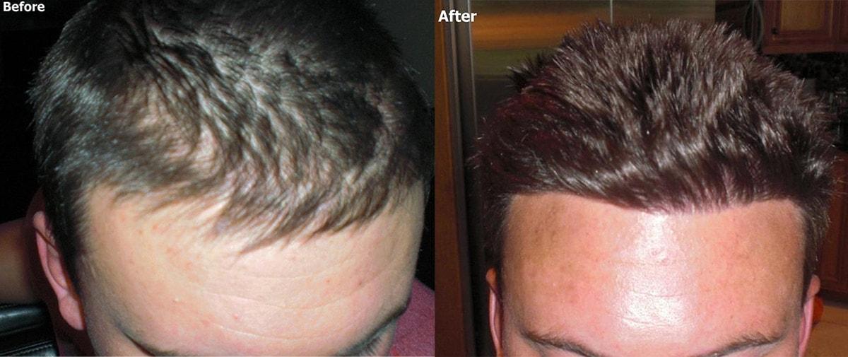 AlviArmani Salt Lake City hair restoration result — Salt Lake City, UT