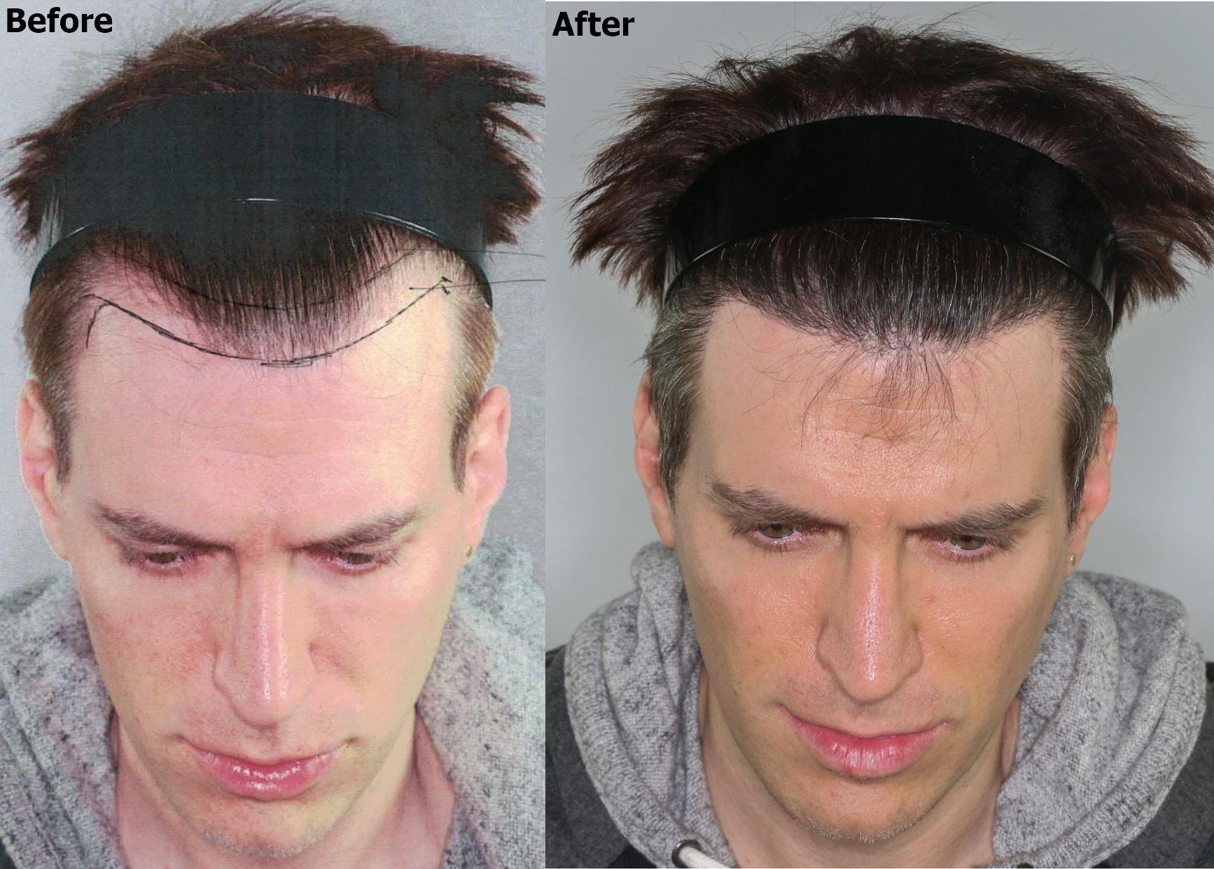 AlviArmani Salt Lake City fue transplant result — Salt Lake City, UT