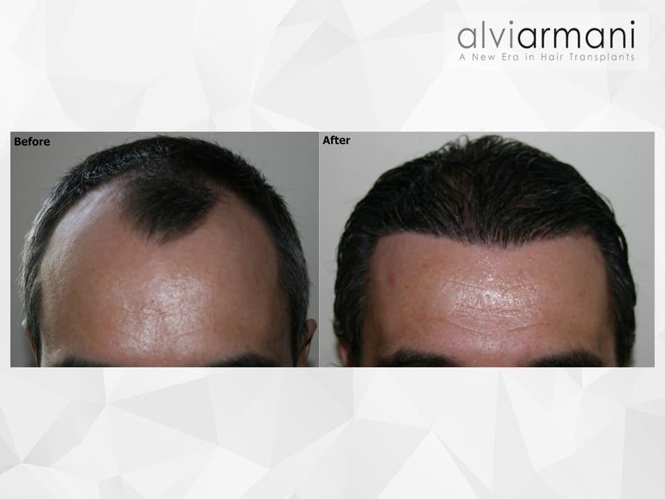 AlviArmani Salt Lake City fue transplant result — Salt Lake City, UT