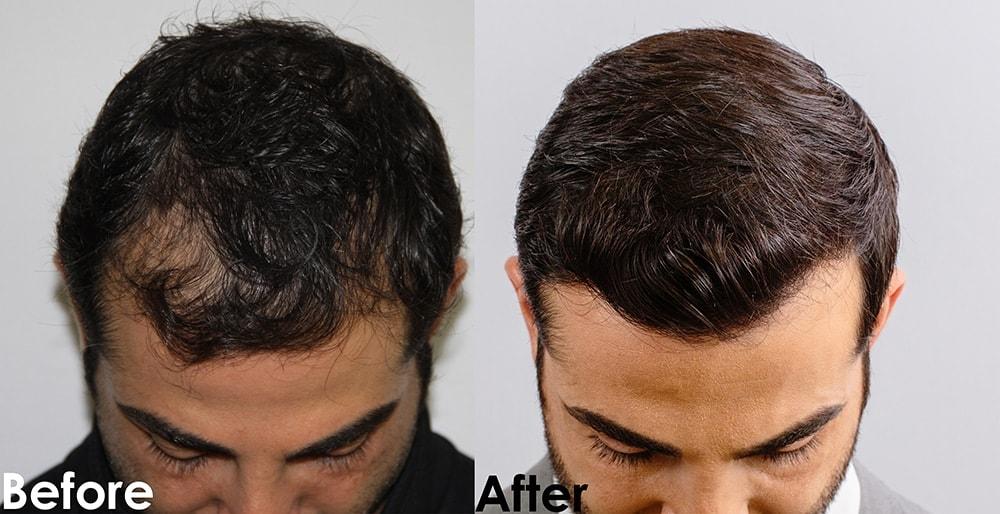 AlviArmani Salt Lake City hair restoration result — Salt Lake City, UT