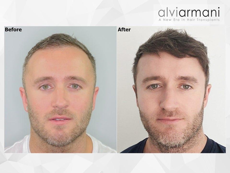 AlviArmani Salt Lake City fue transplant result — Salt Lake City, UT