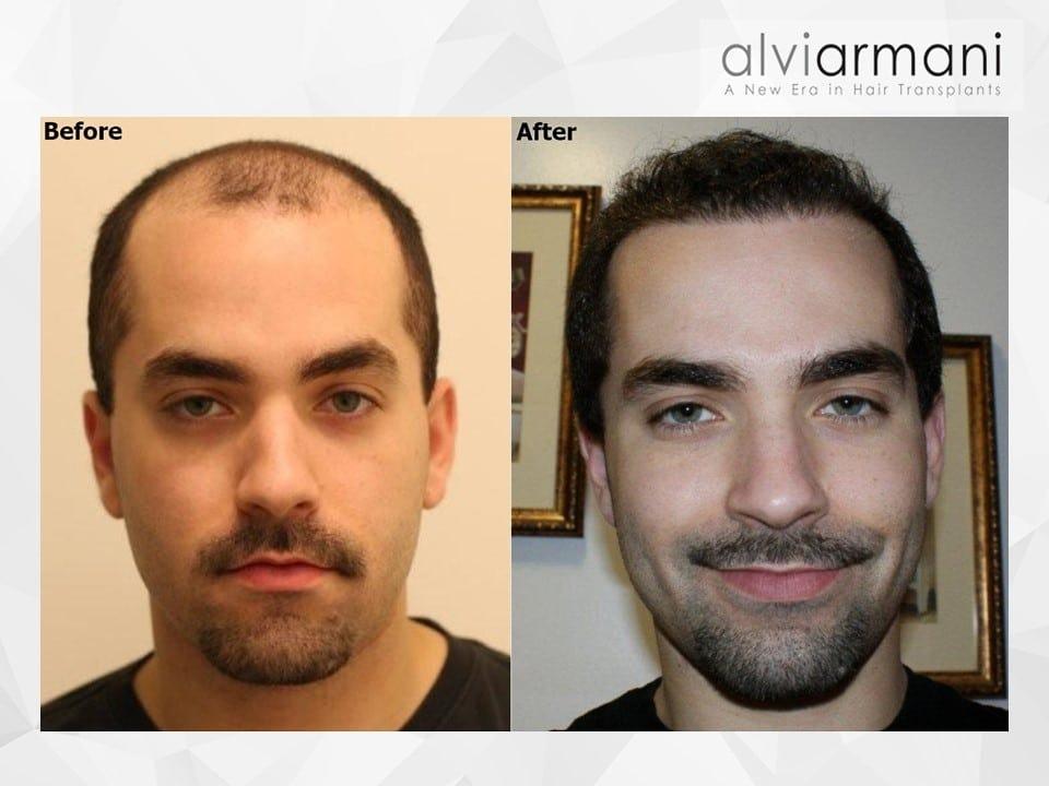 AlviArmani Salt Lake City fue transplant result — Salt Lake City, UT