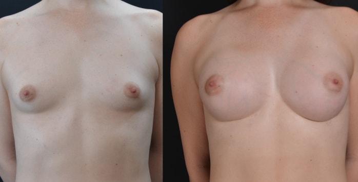 Hetal Fichadia, MD, FACS breast augmentation result — Portland, OR