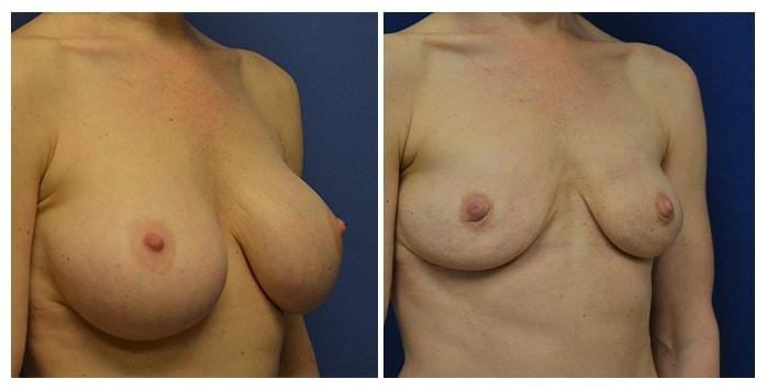 Hetal Fichadia, MD, FACS breast implant removal result — Portland, OR