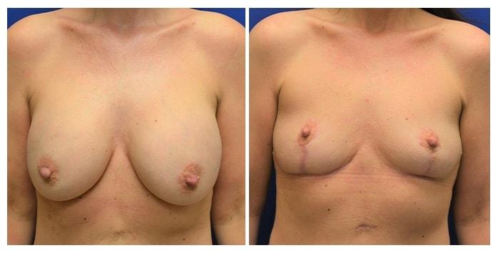 Hetal Fichadia, MD, FACS breast implant removal result — Portland, OR