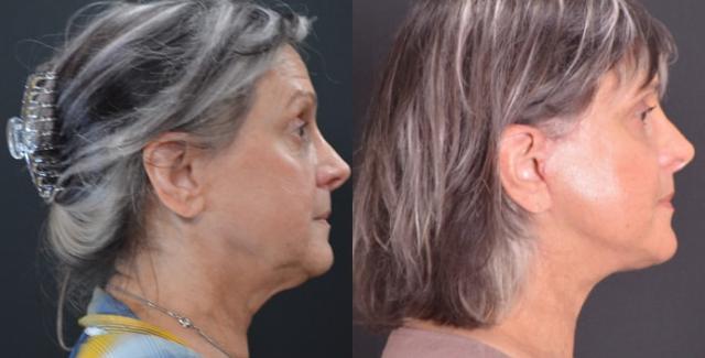 Neck Lift result at Hetal Fichadia, MD, FACS in Portland, OR