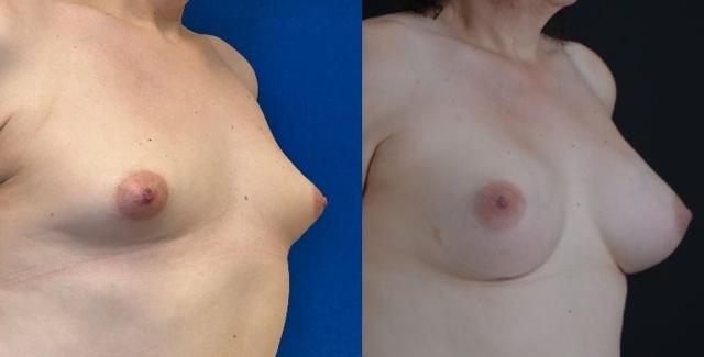 Breast Augmentation result at Hetal Fichadia, MD, FACS in Portland, OR
