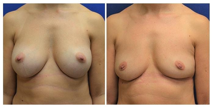 Hetal Fichadia, MD, FACS breast implant removal result — Portland, OR