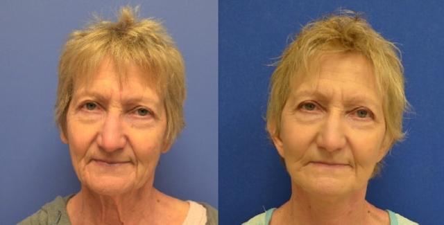 Neck Lift result at Hetal Fichadia, MD, FACS in Portland, OR