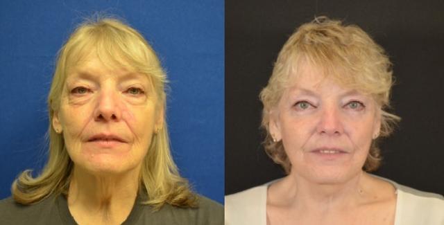 Neck Lift result at Hetal Fichadia, MD, FACS in Portland, OR