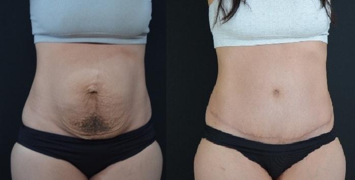 Hetal Fichadia, MD, FACS tummy tuck result — Portland, OR